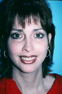 Rhinoplasty After Photo by Dennis Schuster, MD, DDS; Fort Worth, TX - Case 6651