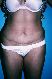 Tummy Tuck After Photo by Dennis Schuster, MD, DDS; Fort Worth, TX - Case 6653