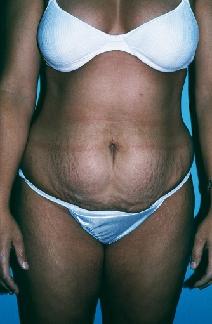 Tummy Tuck Before Photo by Dennis Schuster, MD, DDS; Fort Worth, TX - Case 6653