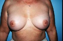 Breast Augmentation After Photo by Dennis Schuster, MD, DDS; Fort Worth, TX - Case 6654