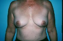 Breast Augmentation Before Photo by Dennis Schuster, MD, DDS; Fort Worth, TX - Case 6654