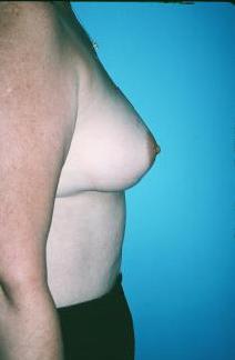 Breast Augmentation Before Photo by Dennis Schuster, MD, DDS; Fort Worth, TX - Case 6654