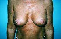 Breast Augmentation After Photo by Dennis Schuster, MD, DDS; Fort Worth, TX - Case 6655