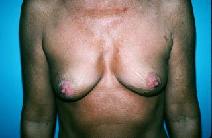 Breast Augmentation Before Photo by Dennis Schuster, MD, DDS; Fort Worth, TX - Case 6655
