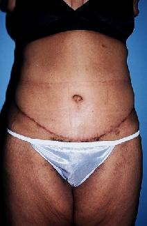 Tummy Tuck After Photo by Dennis Schuster, MD, DDS; Fort Worth, TX - Case 6657