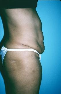 Tummy Tuck Before Photo by Dennis Schuster, MD, DDS; Fort Worth, TX - Case 6657
