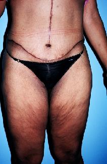 Body Contouring After Photo by Dennis Schuster, MD, DDS; Fort Worth, TX - Case 6658
