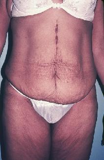 Body Contouring Before Photo by Dennis Schuster, MD, DDS; Fort Worth, TX - Case 6658