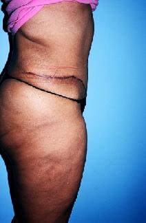 Body Contouring After Photo by Dennis Schuster, MD, DDS; Fort Worth, TX - Case 6658