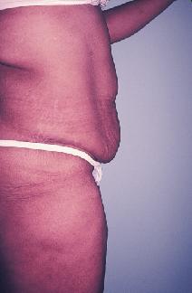 Body Contouring Before Photo by Dennis Schuster, MD, DDS; Fort Worth, TX - Case 6658