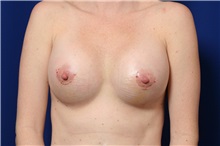Breast Augmentation After Photo by Joseph Mlakar, MD, FACS; Fort Wayne, IN - Case 29490
