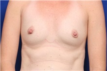 Breast Augmentation Before Photo by Joseph Mlakar, MD, FACS; Fort Wayne, IN - Case 29490