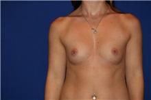 Breast Augmentation Before Photo by Joseph Mlakar, MD, FACS; Fort Wayne, IN - Case 29491
