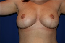 Breast Reduction After Photo by Joseph Mlakar, MD, FACS; Fort Wayne, IN - Case 29504