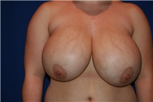 Breast Reduction Before Photo by Joseph Mlakar, MD, FACS; Fort Wayne, IN - Case 29504