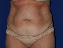 Tummy Tuck Before Photo by Joseph Mlakar, MD, FACS; Fort Wayne, IN - Case 29505