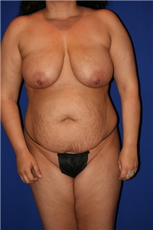 Tummy Tuck Before Photo by Joseph Mlakar, MD, FACS; Fort Wayne, IN - Case 29506