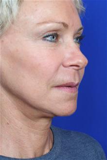 Facelift After Photo by Joseph Mlakar, MD, FACS; Fort Wayne, IN - Case 29508