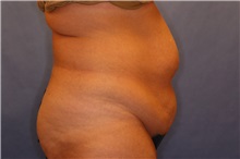 Tummy Tuck Before Photo by Joseph Mlakar, MD, FACS; Fort Wayne, IN - Case 29575