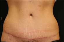 Tummy Tuck After Photo by Joseph Mlakar, MD, FACS; Fort Wayne, IN - Case 29576