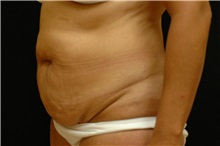 Tummy Tuck Before Photo by Joseph Mlakar, MD, FACS; Fort Wayne, IN - Case 29576
