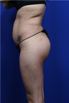 Buttock Lift with Augmentation After Photo by Joseph Mlakar, MD, FACS; Fort Wayne, IN - Case 29582