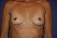Breast Reconstruction Before Photo by Joseph Mlakar, MD, FACS; Fort Wayne, IN - Case 29599