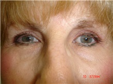 Eyelid Surgery After Photo by Howard Perofsky, MD; Macon, GA - Case 21505