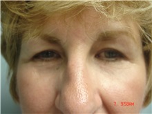 Eyelid Surgery Before Photo by Howard Perofsky, MD; Macon, GA - Case 21505