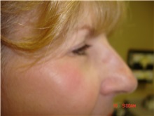 Eyelid Surgery After Photo by Howard Perofsky, MD; Macon, GA - Case 21505