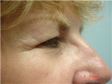 Eyelid Surgery Before Photo by Howard Perofsky, MD; Macon, GA - Case 21505