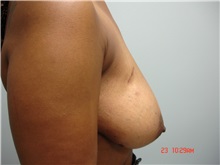 Breast Reduction Before Photo by Howard Perofsky, MD; Macon, GA - Case 8532