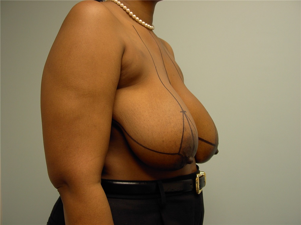 Breast Reduction Before and After Photos by Howard Perofsky, MD; Macon, GA  - Case 8533