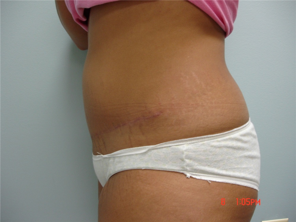 Breast Reduction Before and After Photos by Howard Perofsky, MD; Macon, GA  - Case 8533