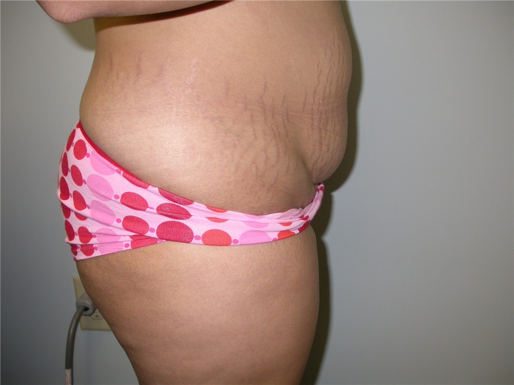 Tummy Tuck Before and After Photos by Howard Perofsky, MD; Macon, GA - Case  8538