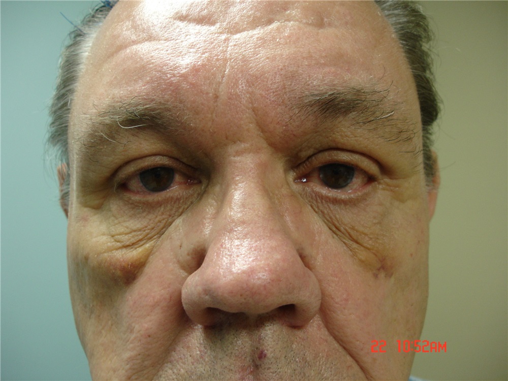 Facelift Before and After Photos by Howard Perofsky, MD; Macon, GA - Case  8541