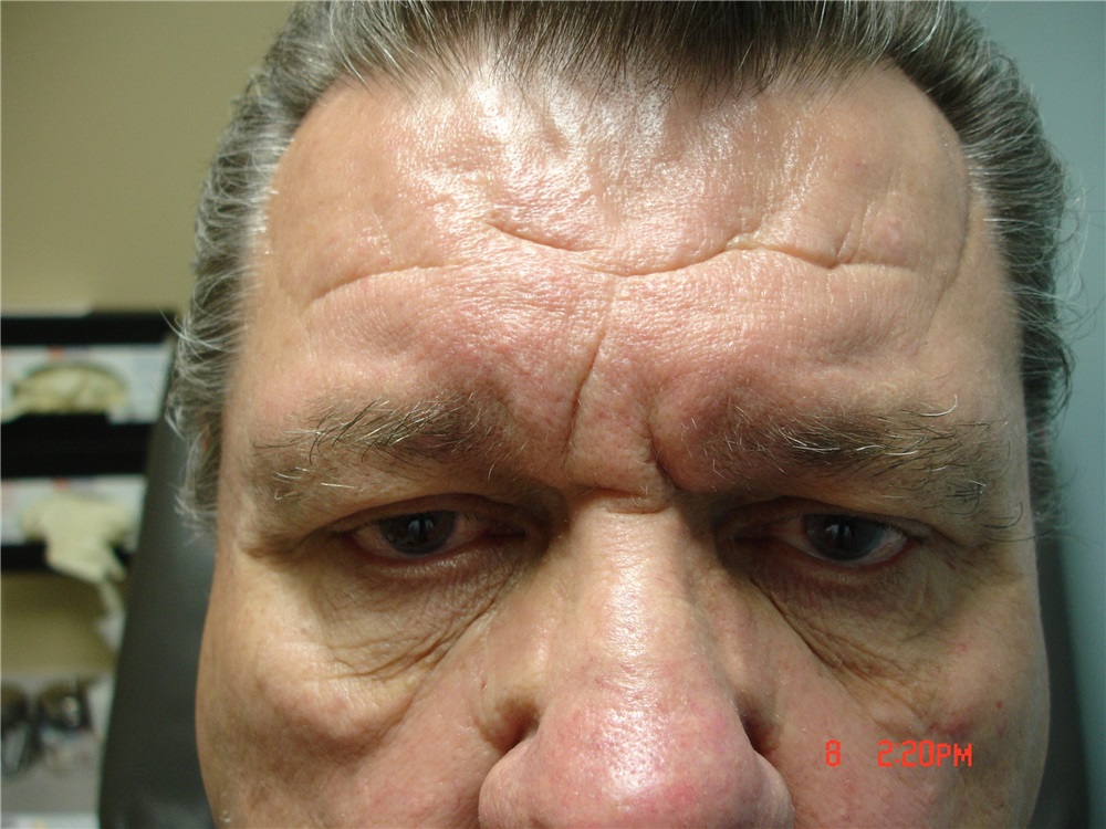 Facelift Before and After Photos by Howard Perofsky, MD; Macon, GA - Case  8541