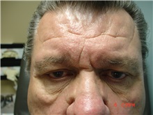Facelift Before Photo by Howard Perofsky, MD; Macon, GA - Case 8541