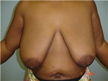 Breast Reduction Before Photo by Howard Perofsky, MD; Macon, GA - Case 8573
