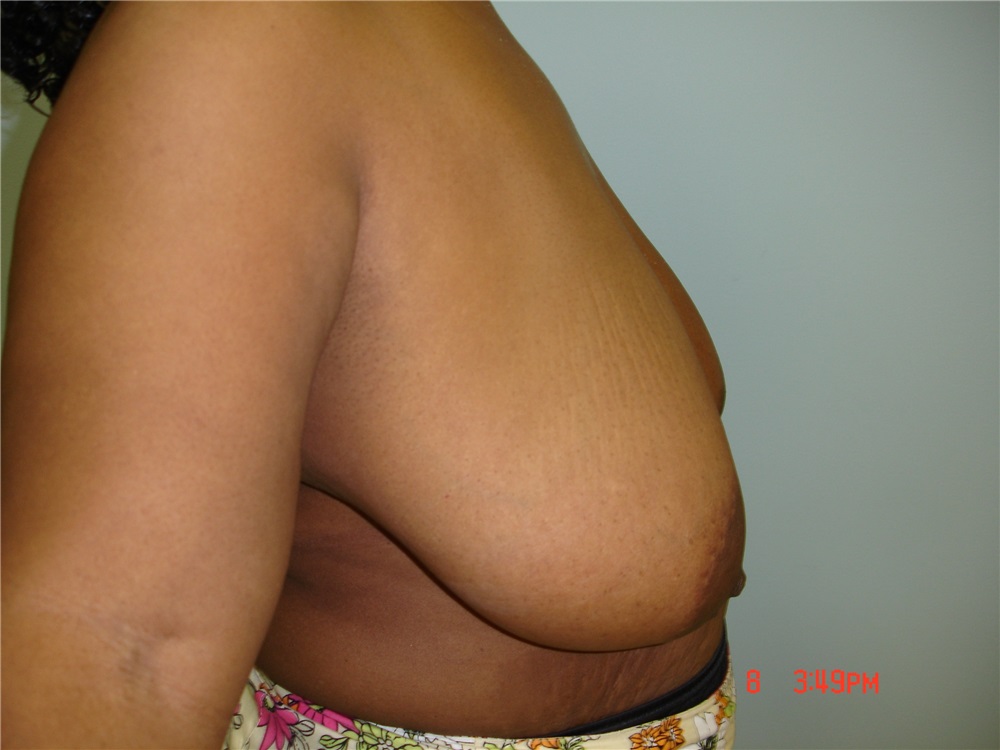 Breast Reduction Before and After Photos by Howard Perofsky, MD; Macon, GA  - Case 8573