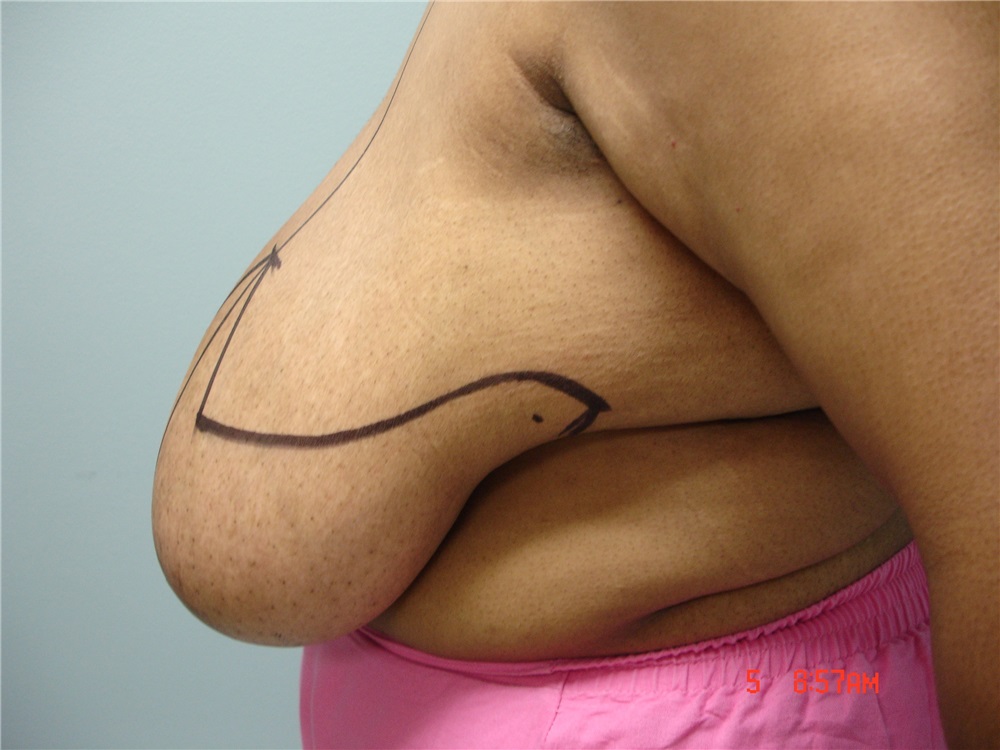 Breast Reduction Before and After Photos by Howard Perofsky, MD; Macon, GA  - Case 8574