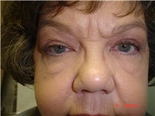 Eyelid Surgery After Photo by Howard Perofsky, MD; Macon, GA - Case 8586