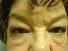 Eyelid Surgery Before Photo by Howard Perofsky, MD; Macon, GA - Case 8586