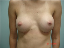 Breast Augmentation After Photo by Howard Perofsky, MD; Macon, GA - Case 8605