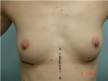 Breast Augmentation Before Photo by Howard Perofsky, MD; Macon, GA - Case 8605