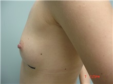 Breast Augmentation Before Photo by Howard Perofsky, MD; Macon, GA - Case 8605
