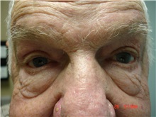 Eyelid Surgery After Photo by Howard Perofsky, MD; Macon, GA - Case 8644