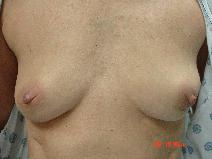 Breast Reconstruction Before Photo by Howard Perofsky, MD; Macon, GA - Case 8645