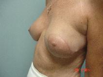 Breast Reconstruction After Photo by Howard Perofsky, MD; Macon, GA - Case 8645
