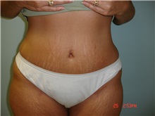 Tummy Tuck After Photo by Howard Perofsky, MD; Macon, GA - Case 8721